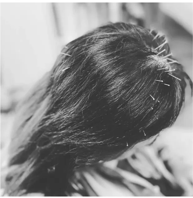scalp acupuncture