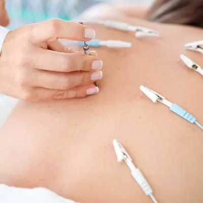 Doctor applying electroacupuncture on a patient’s back Doctor applying electroacupuncture on a patient's back