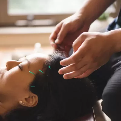 Young woman at the acupuncture treatment scalp acupuncture